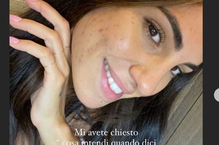 Giulia De Lellis e la foto con i segni dell’acne: ‘Senza filtri è una storia diversa’